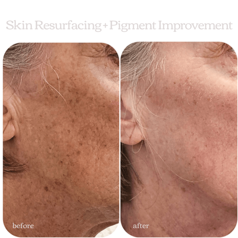 Skin Resurfacing and Pigment Improvement