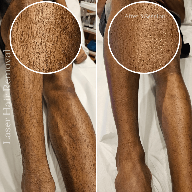 Laser Hair Removal